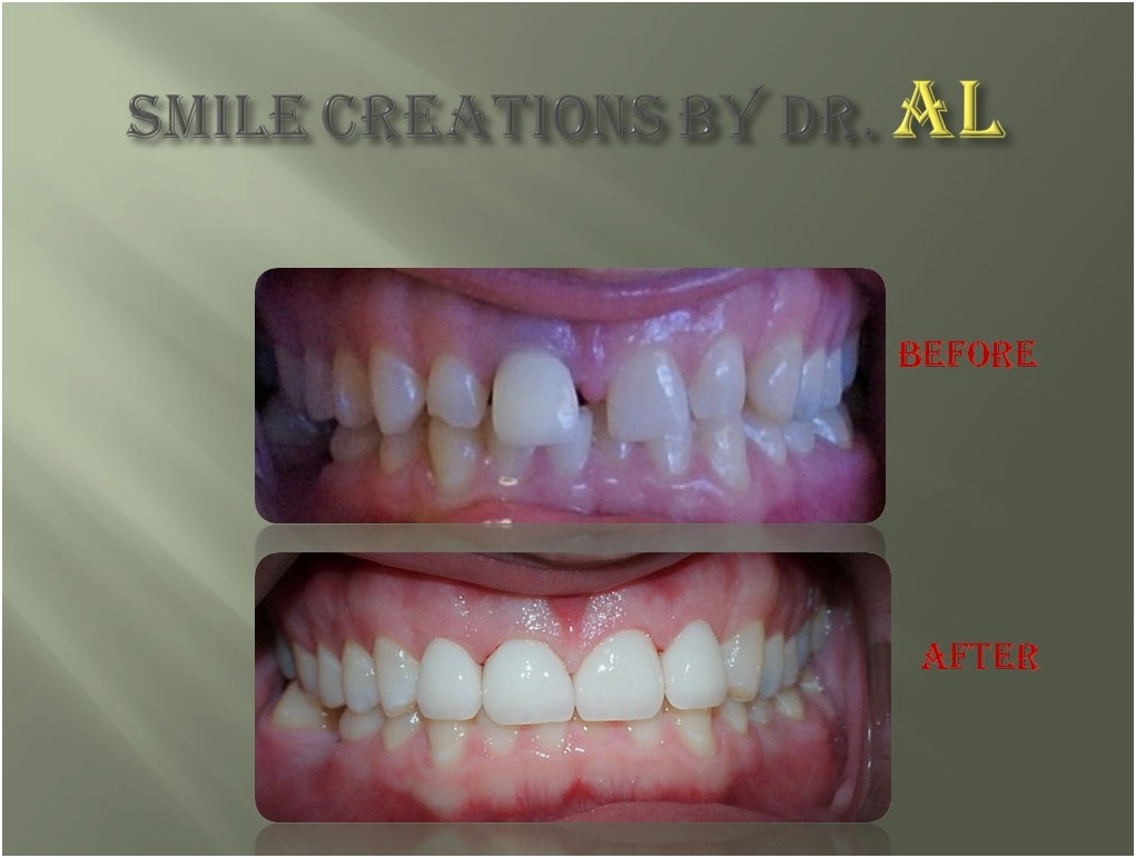 Before and After Case #6 Photo