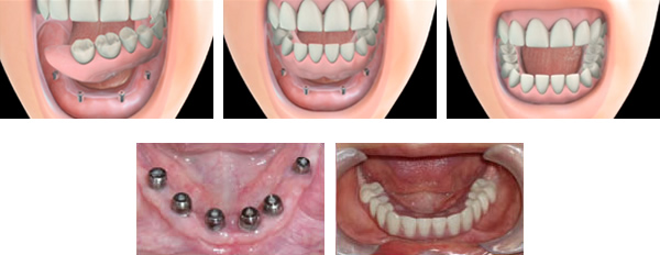 Dental Dentures